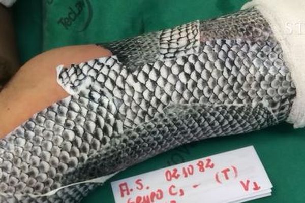ブラジルの医師が火傷の治療で魚の皮を使用、効果が確認され話題に