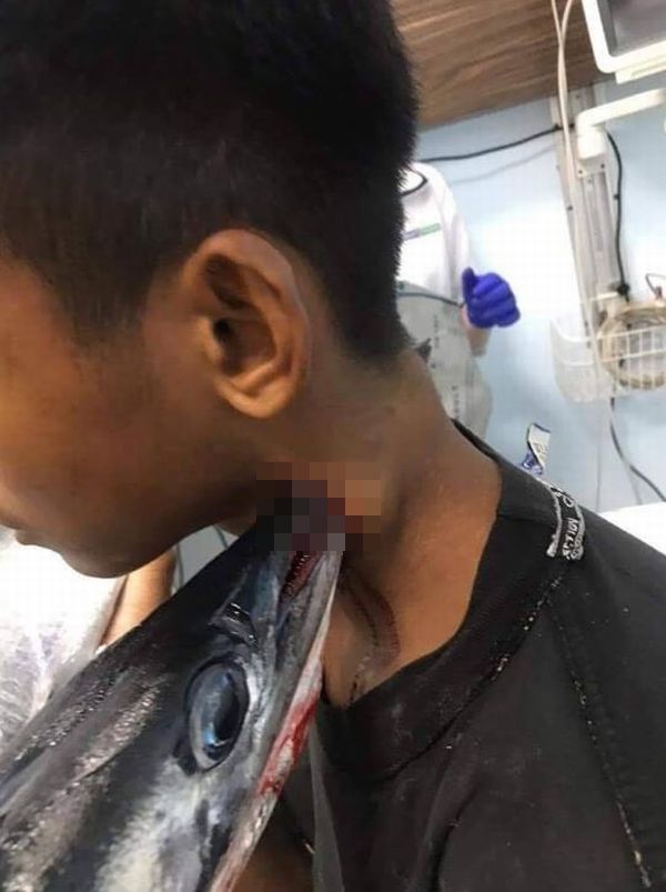 インドネシアの青年の喉に 海面から飛び跳ねた魚の口が突き刺さる Switch News スウィッチ ニュース