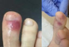 足指の変色は新型コロナの可能性　スペインの医師団が指摘