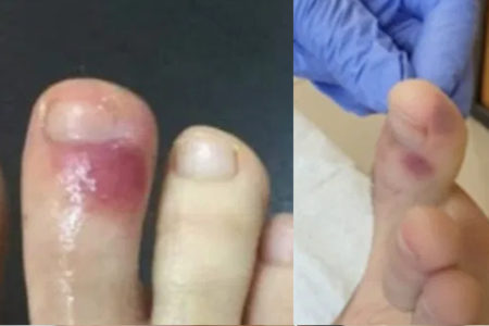 足指の変色は新型コロナの可能性　スペインの医師団が指摘