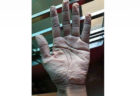 コロナ治療で手袋をはめ続ける医師の手 痛ましい写真が話題に