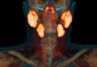 人体に未知の臓器が見つかる、オランダ癌研究所が鼻の奥に大きさ3.5cmの腺を発見