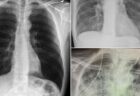 新型コロナ陽性患者の肺、喫煙者よりもひどい胸のX線写真が衝撃的
