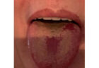 新型コロナウイルスの専門家が、舌に出る症状の写真をツイート
