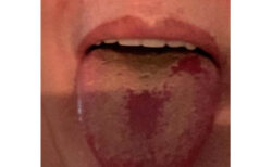 新型コロナウイルスの専門家が、舌に出る症状の写真をツイート