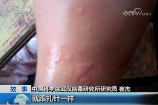 武漢ウイルス研究所での調査の実態を示す動画、コウモリに咬まれ腫れる様子も