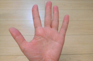 親指どこまで曲がる?隠れた大動脈瘤を知る簡単なテストが、論文として発表された