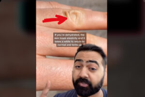 夏に備え、皮膚をつまんで脱水状態を知る方法を、ドクターが動画でシェア