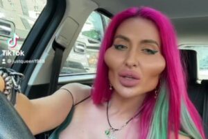 フィラーを注入し続けて頬が膨らんだ女性、英の番組に出演し心境を語る