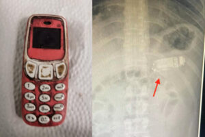 腹痛の男性患者は、携帯電話を丸ごと飲み込んでいた！