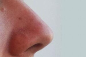 世界で最も大きな鼻を持つ男性とは?未だにギネス世界記録も破られず