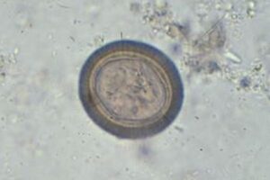 脳内にいた寄生虫が死滅していても、発作を起こした米男性の症例