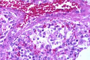 欧米で広がっている謎の小児肝炎、原因はアデノウイルスか？