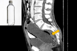 便秘で来院した患者、CTを撮るとお尻の中にペットボトルが