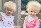 イギリスの1才女児、「櫛でとかせない頭髪症候群」と診断される