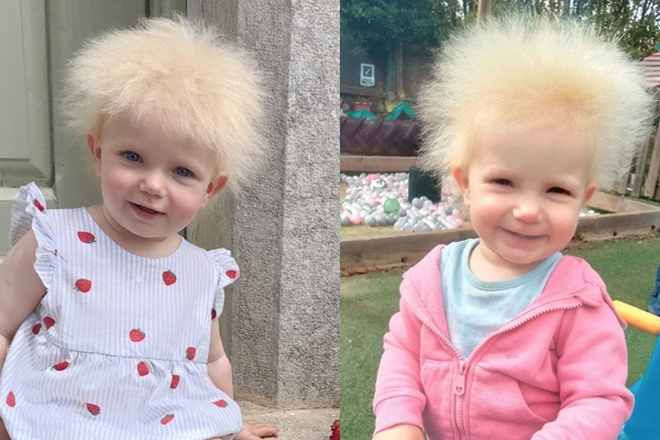 イギリスの1才女児、「櫛でとかせない頭髪症候群」と診断される