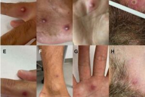 イタリア人男性が新型コロナとサル痘、HIVに同時感染、珍しい症例を報告