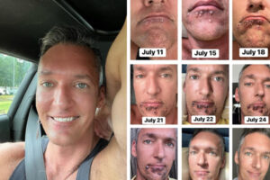 アメリカのサル痘患者が、自撮りで進行を詳しく紹介