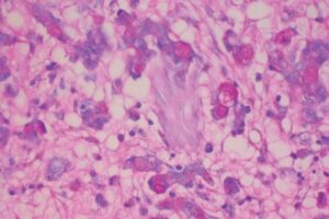 ウイルスを利用した新たなガンの治療法、人への臨床試験で大きな可能性を示す