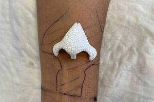 患者の腕の中で鼻を育て、顔への移植に成功【フランス】