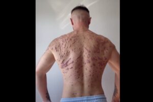 ボディビルダーが筋肉増強剤の無残な副作用を動画で公開