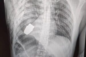 爆発する可能性のあった手榴弾、医師がウクライナ兵の胸から摘出