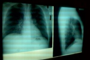 過去30年間で、癌の死亡率が32％減少【アメリカ】