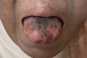 日本人女性の舌に黒い毛のようなものが生える、抗生物質の影響か？