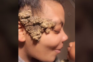 顔の痣が肥大して房になる奇病、医者も恐れて手を出さず