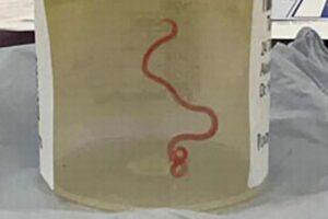 女性の脳に長さ8cmの回虫を発見、人に寄生した初の症例