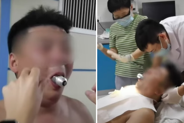 動画を真似た中国人男性、電球が口にはまって取れなくなる