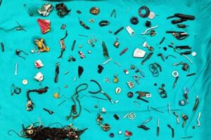 医者もびっくり！胃の痛みを訴えていた患者、150個の異物を飲み込んでいた！