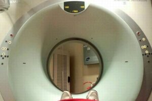 80歳の女性の脳に針が刺さっているのを発見、親による嬰児殺しの試みか【ロシア】