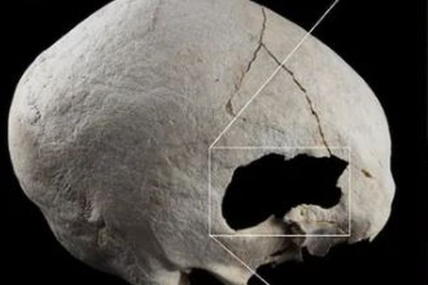 4千年以上も前の頭蓋骨に手術の痕跡、しかも患者が生き延びていた可能性