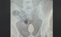病院に運ばれた女性の下腹部レントゲンに、お尻の栓が写ってしまう