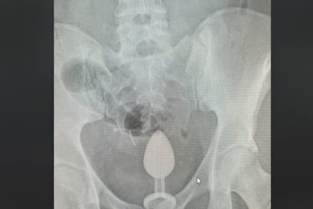 病院に運ばれた女性の下腹部レントゲンに、お尻の栓が写ってしまう