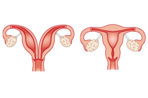 2つの子宮を持つ女性が、両方で同時に妊娠