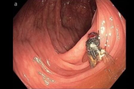 人の大腸の中に生きたハエがいた！医師が画像付きで報告