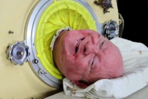 72年間も人工肺のシリンダーで過ごし、弁護士の資格も取得した男性が死亡