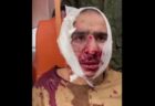 【ロシア・テロ事件】兵士が捕まえた容疑者の耳を切断、口に押し込む
