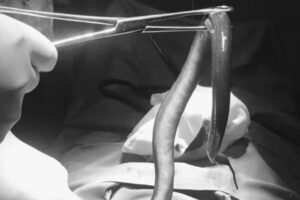 男性の胃から生きたウナギを発見、手術をした医者も驚愕【ベトナム】