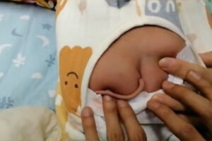 お尻から10cmの尻尾が生えた赤ちゃんが中国で生まれた