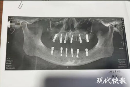 1日に23本の歯を抜いて12本をインプラントにした男性、後日死亡【中国】