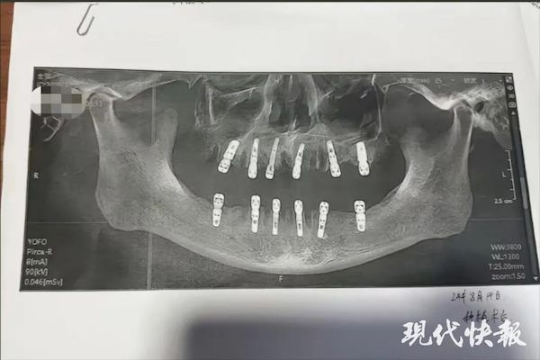 1日に23本の歯を抜いて12本をインプラントにした男性、後日死亡【中国】