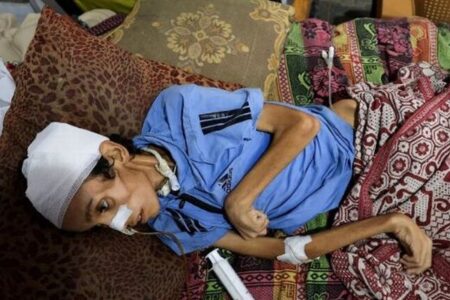 ガザ地区では5000人の子供たちが栄養失調で入院：ユニセフ