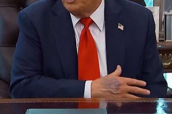 トランプ氏の右手の甲に奇妙なアザ、健康上の疑惑が浮上