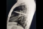 乳首から白い膿が出た男性、胸の中にナイフの刃が埋まっていた