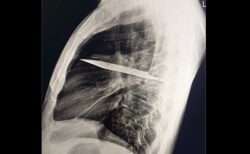 乳首から白い膿が出た男性、胸の中にナイフの刃が埋まっていた