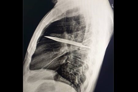 乳首から白い膿が出た男性、胸の中にナイフの刃が埋まっていた
