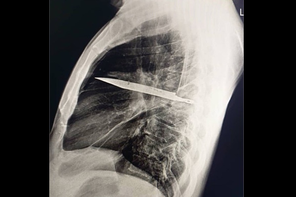 乳首から白い膿が出た男性、胸の中にナイフの刃が埋まっていた